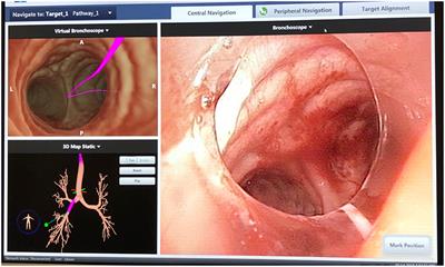 The Utility of Near-Infrared Fluorescence and Indocyanine Green During Robotic Pulmonary Resection